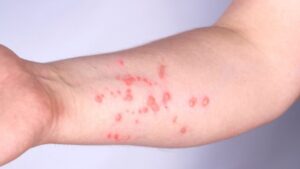 Vitória da Conquista registra caso de Mpox; Bahia soma duas confirmações em 2026